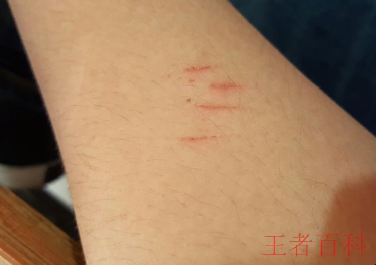 被打了疫苗的猫抓伤需要打针吗